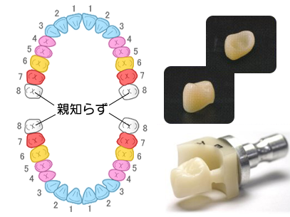 CAD／CAM冠の保険適用部位について